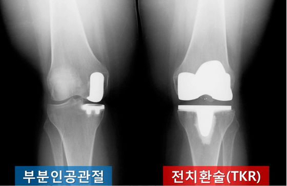 비가 오면 무릎이 쑤시는 이유가 있네