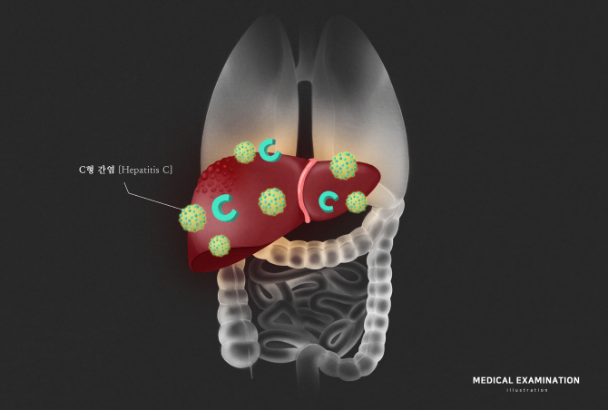 만성 B.C형 간염, 6개월 이상 지속되면 간암 발병률 높여 주의