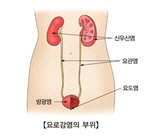 여름 물놀이땐 '급성신우신염' 잘 걸려 주의해야