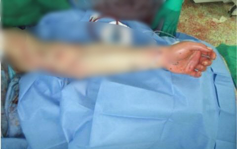 장병 잘린 팔 붙인 이국종 교수 제자…"피부만 붙어있던 상황"