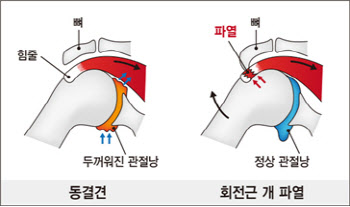 어깨 아프면 다 오십견 아냐... 정확한 진단이 치료 첫걸음