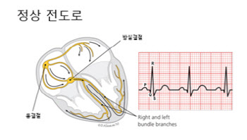 “갑자기 심장이 빨리 뛰고 가슴이 답답하다… ‘발작성 상심실성 빈맥’ 의심