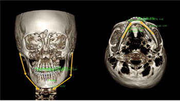 디지털 기술로 더욱 정교하게, 안면비대칭 턱교정수술
