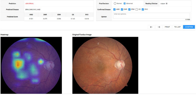 Gangbuk Samsung Hospital automatically diagnoses eye diseases…  Deep learning algorithm development