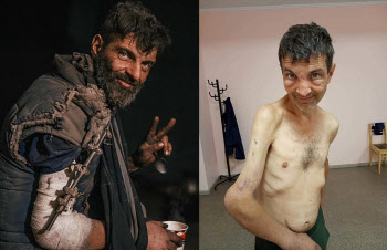 앙상한 몸, 뒤틀린 팔… 러시아 포로였던 우크라 군인의 충격 전후