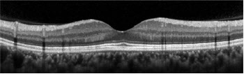 망막 황반부의 ‘신경섬유층’ 두께 얇으면 치매 위험 증가한다
