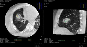 대장암 폐 전이 환자, 고주파 열 치료술 효과 확인