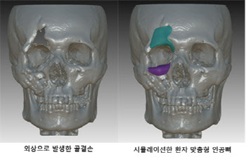 안면골 및 두개골 결손, 3D프린터 통한 인공 뼈로 신 치료길 열려