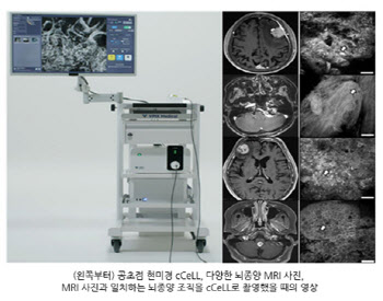 초소형 디지털 조직진단 장비 cCeLL을 통한 ‘수술 중 실시간 뇌종양 진단’ 가능