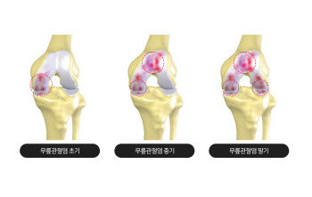 한국인들이 ‘암’ 다음으로 걱정하는 질병은?, '관절염'