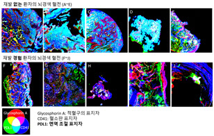 뇌경색 환자, 혈전 성질에 따라 재발 가능성 달라