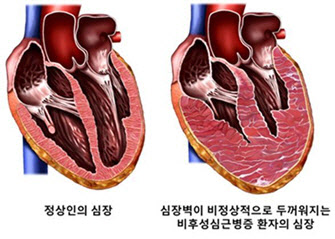 비후성심근증 환자, 심장 수축기능 정상이라도 예후 나쁠 수 있어