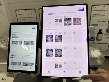 "현재 탈모 상태는요"…AI '모발 검사' 직접 해보니