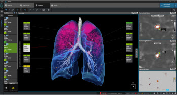 코어라인소프트, 판독영역 본격확장…“흉부 의료AI 선두주자 굳히기”