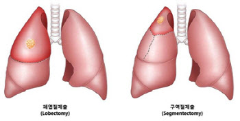 구역절제술 받은 비소세포폐암 환자 예후 AI로 예측 가능