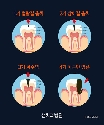 충치 발생률 높은 여름, 치아건강 위협하는 여름식품은?