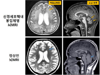 희귀 신경질환 신경세포핵내봉입체병 진단 해결 실마리 찾아