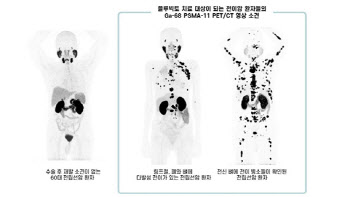 서울아산병원, 전립선암 혁신 치료제 ‘플루빅토’ 본격 도입