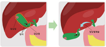 담낭 질환, 정확하게 알고 빠르게 치료하는게 중요