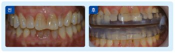 자다 말고 ‘컥컥’ 폐쇄성 수면무호흡증, 치과 치료로 해결