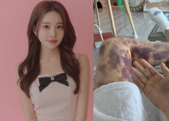 '건강주사'에 전신 피멍 아옳이…병원 상대 ‘13억 소송’ 승소