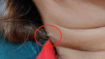 2주 전 삼킨 ‘생선 가시’, 목 뚫고 나와…“이것 하지 마세요”
