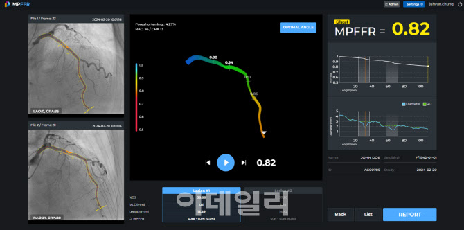 메디픽셀, 심근 FFR AI 'MPFFR-1000' 식약처 허가 획득 - 뉴스 썸네일 이미지
