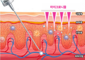 라파스, 세계 첫 마이크로니들 패치 면역치료제 상용화 청신호...다음은?