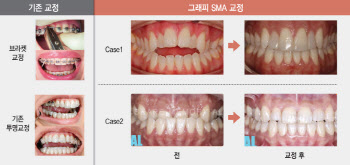 “소아부터 노인까지 시장 무한 확장” 형상기억 투명교정장치[그래피 대해부]②