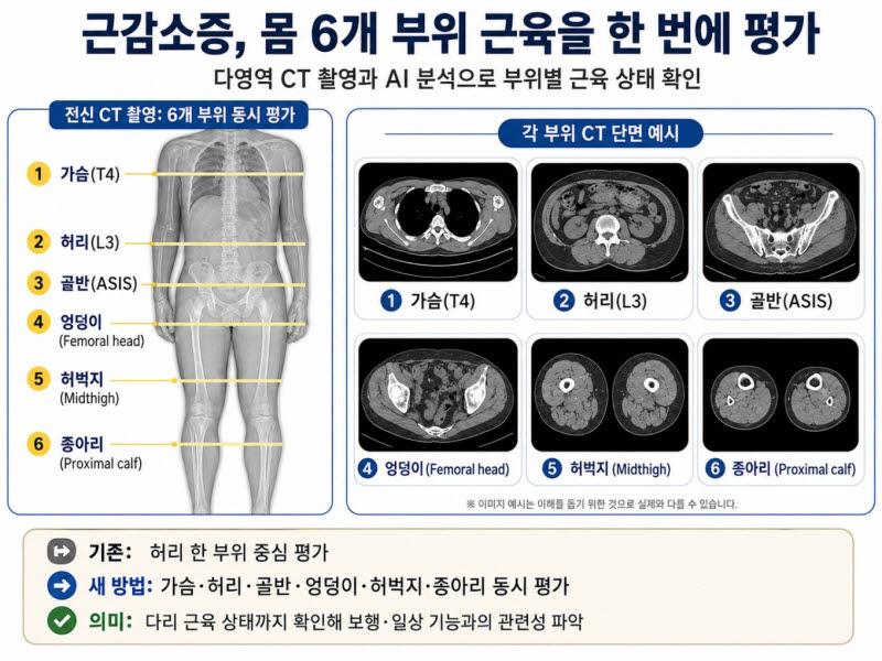 초고령사회 맞아 국내서 개발된 다영역 CT 근감소증 평가법