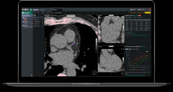 코어라인소프트, 美병원 판독실에 AI 심는다…북미 상용 워크플로우 확장