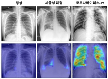 흉부X선 촬영만으로 코로나19 신속·정확 진단...'개도국'도 쉽게 쓴다