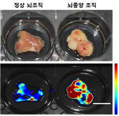 뇌종양, 이젠 5분 이내에 신속하고 정확하게 진단한다