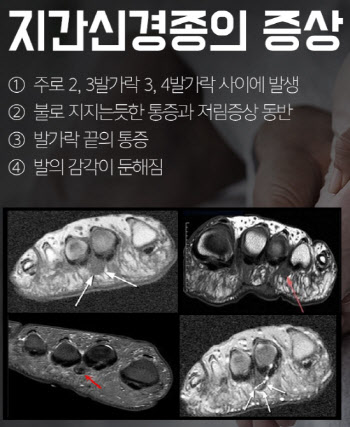 뜨겁고 찌릿한 발바닥, 너무 더워서 그런 걸까?