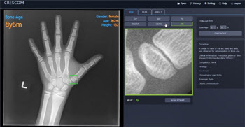 “AI가 영상판독의 정확도로 뼈 나이 판정 가능”