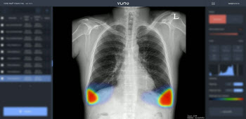 뷰노 “AI 흉부 엑스레이 소프트웨어, 서울아산병원서 활용”