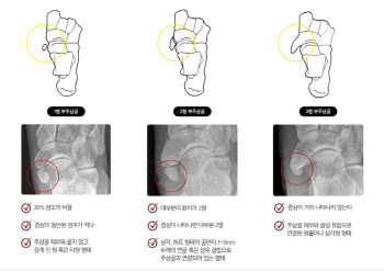 후천적 평발 만드는 ‘부주상골증후군’, 아이들 발 수시로 살펴봐야