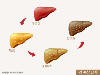 간경화로 가는 비알코올성 지방간염, 치료제 개발 실마리 찾았다