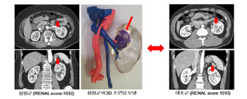 ‘3D 프린팅 신장 모형’으로 신장암 로봇수술 시간 단축한다