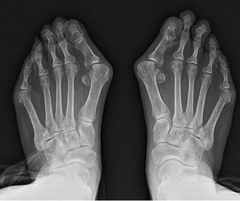 고령화로 엄지발가락 변형 환자 증가...방치하면 척추.관절에도 악영향