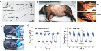수술부위에 봉합 '센서' 개발···인대·아킬레스건 치료 효과적으로