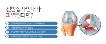 무릎 전방십자인대파열, 젊다고 방치하지 말아야