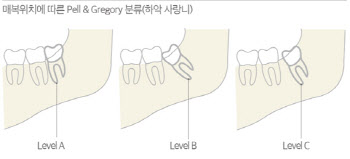 있어도 걱정 빼는 것도 걱정, 사랑만큼 어려운 ‘사랑니’