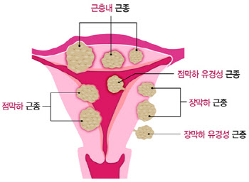 가임기 여성 20~40%가 있지만 잘 모르는 '자궁근종'