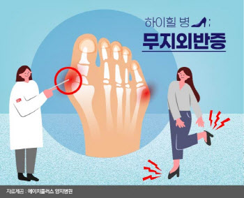 여름철, '예쁜 발' 뽐내다 '못난 발' 될 수 있다.