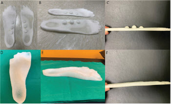 족저근막염 환자 걸음 편하게 하는 새로운 디자인의 안창 개발
