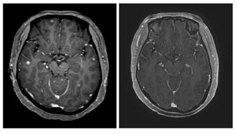 타그리소, 진료현장에서 뇌전이 EGFR 변이 폐암에 효과