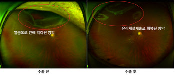 눈 앞 커튼 쳐진 듯한 증상의 망막박리, 급히 안과 검사 받아야