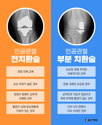 내 관절 보존하고 닳은 관절만 바꿔주는 인공관절 부분치환술