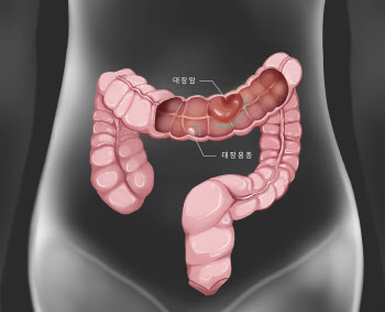 변 보기 힘든 젊은 층, 변비 때문이라고 만 생각하시나요?